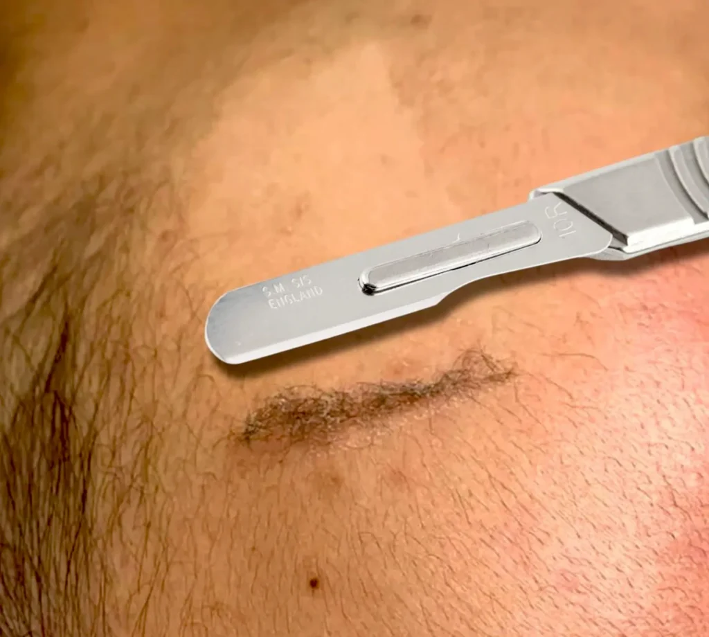 Good Eats Inc | What do dermatologists say about dermaplaning? Is Dermaplaning Just a Trend