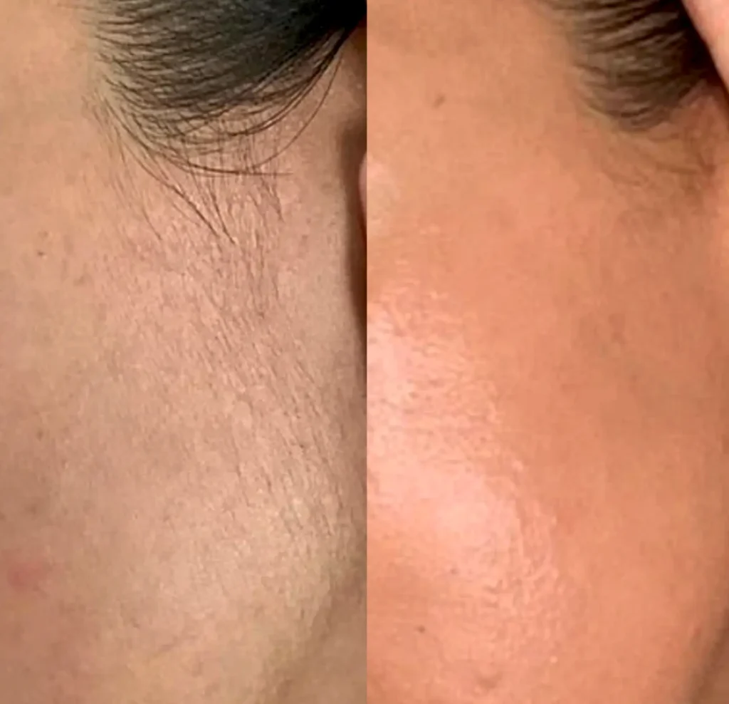 Good Eats Inc | What do dermatologists say about dermaplaning? What Are the Claimed Benefits