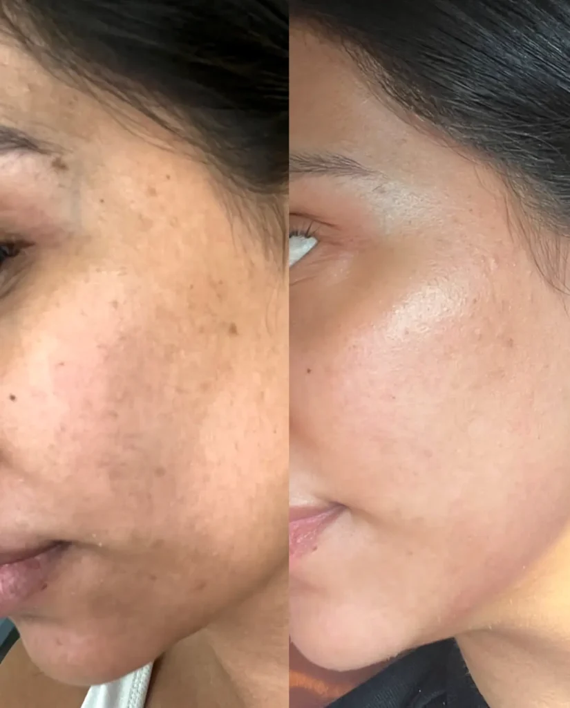 Good Eats Inc | What do dermatologists say about dermaplaning? What Is Dermaplaning