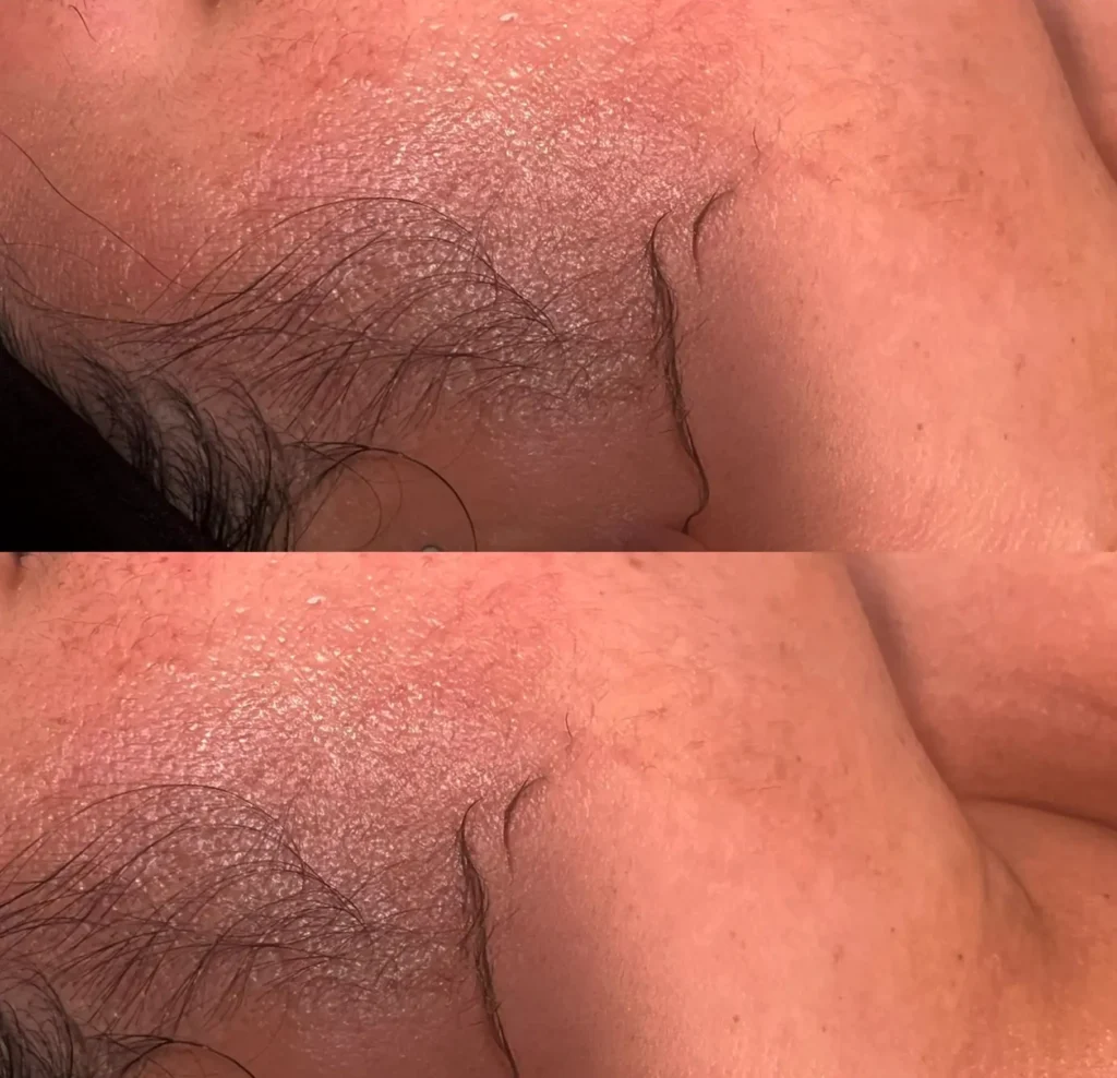 Good Eats Inc | What do dermatologists say about dermaplaning? What Skin Types Is It Best For