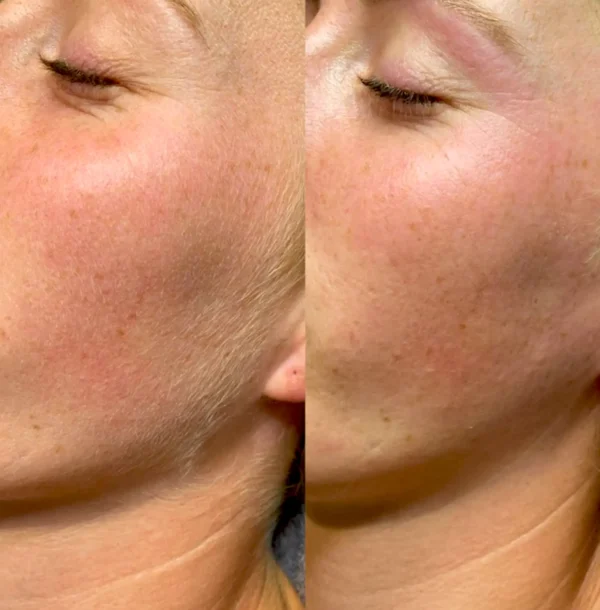 What do dermatologists say about dermaplaning?