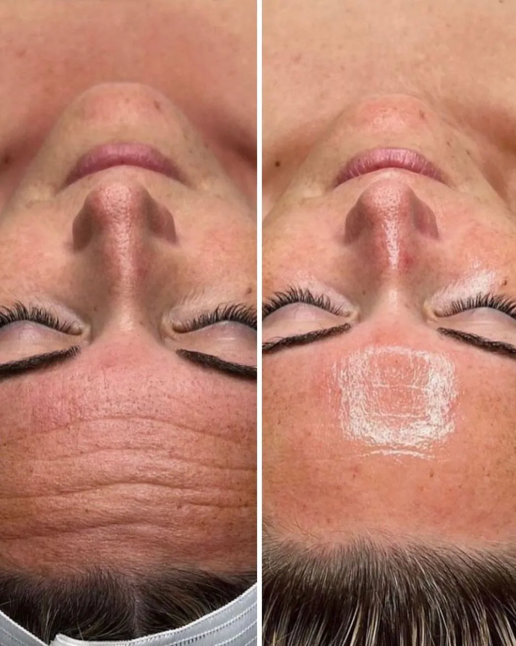 hydrojelly facial