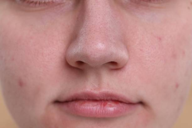 Close-up of a person's lower face showing nose, mouth, and skin texture