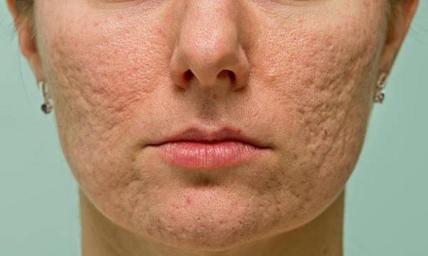 Banish Pesky Facial Bumps: Effective Remedies for Smooth Skin