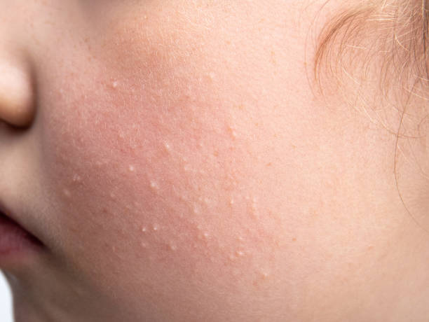 Close-up image of a person's cheek showing visible pores and minor skin imperfections.