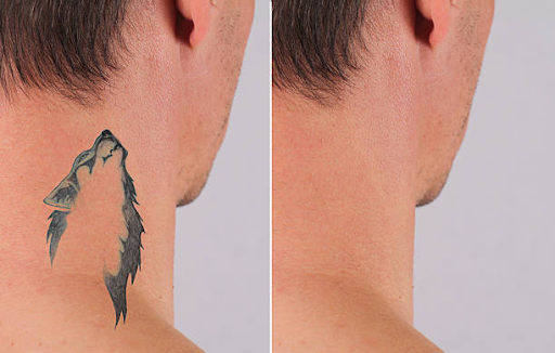 Comprehensive Guide to Tattoo Removal: Efficacy, Methods, and Expectations