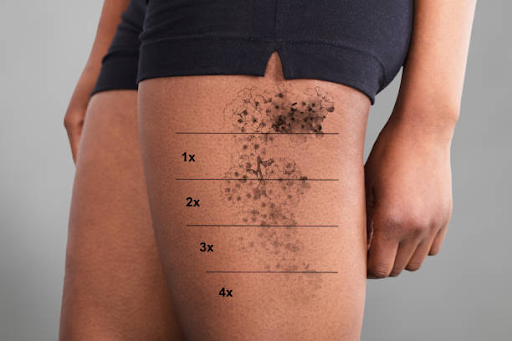 Melbourne's tattoo erasure treatments